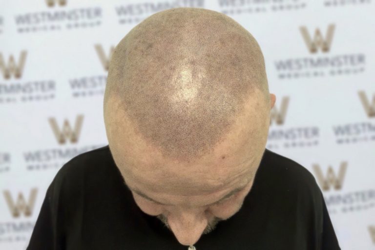 Top view of a bald man's head undergoing hair regrowth, against a backdrop with a repetitive "westminster" logo pattern.