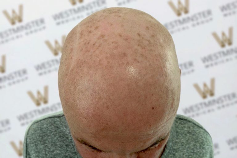Close-up image of a bald head of a man against a background with a repetitive 'w' logo pattern. The head shows natural skin textures and slight blemishes from hair surgery.