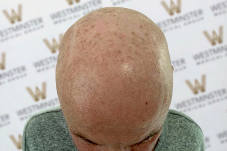 Close-up image of a bald head of a man against a background with a repetitive 'w' logo pattern. The head shows natural skin textures and slight blemishes from hair surgery.
