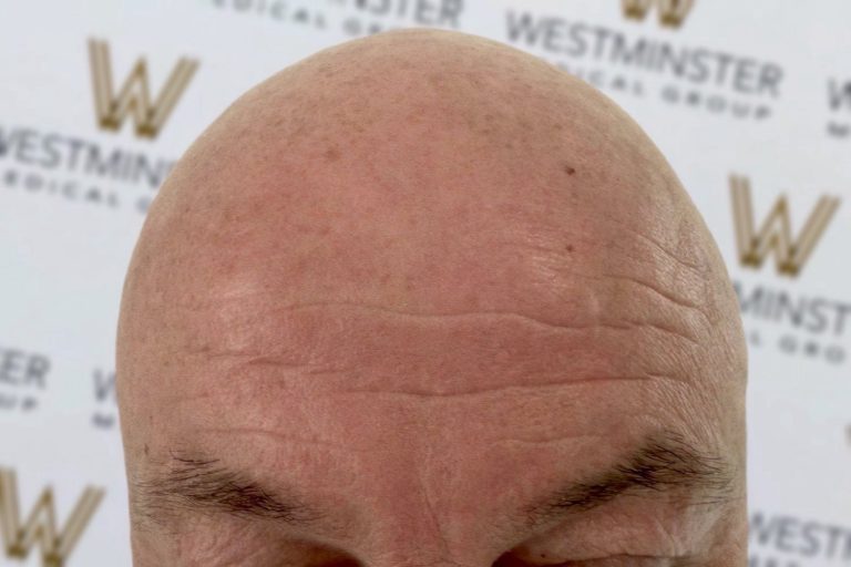 Close-up of a bald head, showing signs of male pattern baldness, with visible wrinkles on the forehead and eyebrows partially in view, set against a backdrop featuring the "westminster" logo.