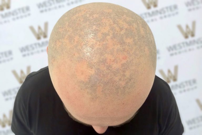 Top view of a bald man's head showing a pattern of hair follicles and natural skin texture indicative of hair regrowth, with a blurred background featuring event banners.