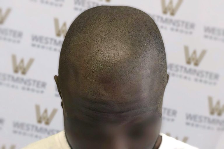 Close-up photo of the top of a person's head, showing signs of female hair loss, against a backdrop with "Westminster" and "www" logos. The person's face is not visible