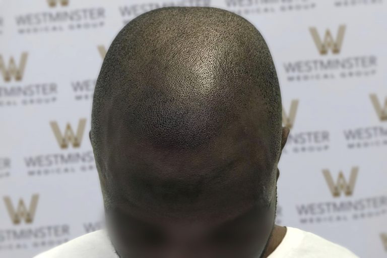 A close-up photo of a person's head with textured hair replacement and a blurred face, standing against a background featuring multiple logos that say "Westminster.