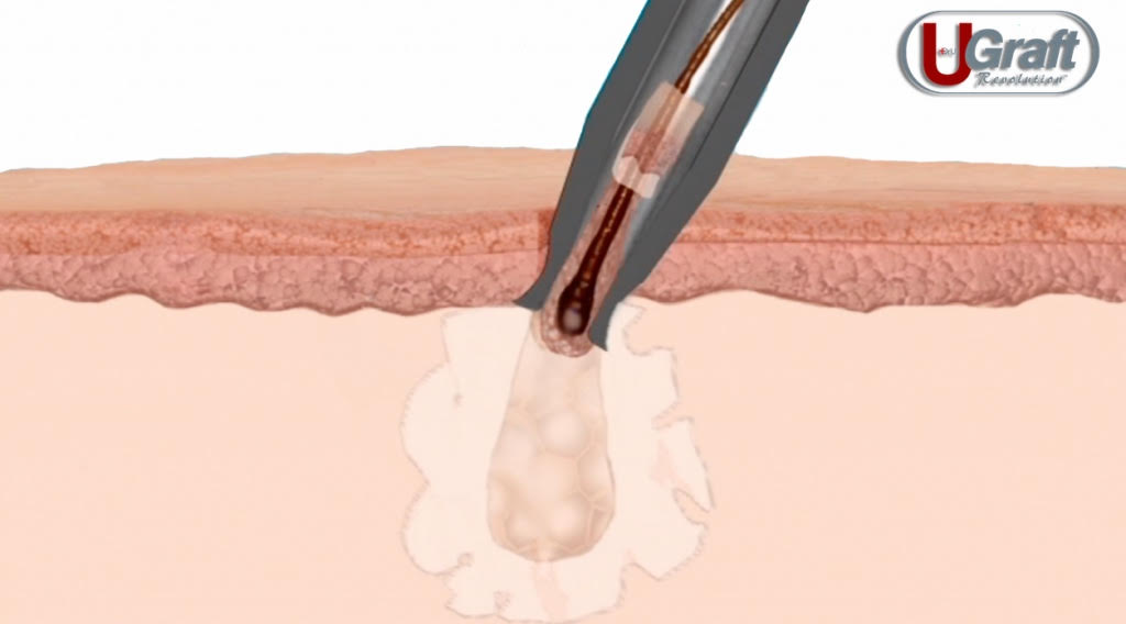 Illustration showing a micro-needle administering a hair regrowth substance into human skin, depicted with a focus on the needle tip and the layers of skin.
