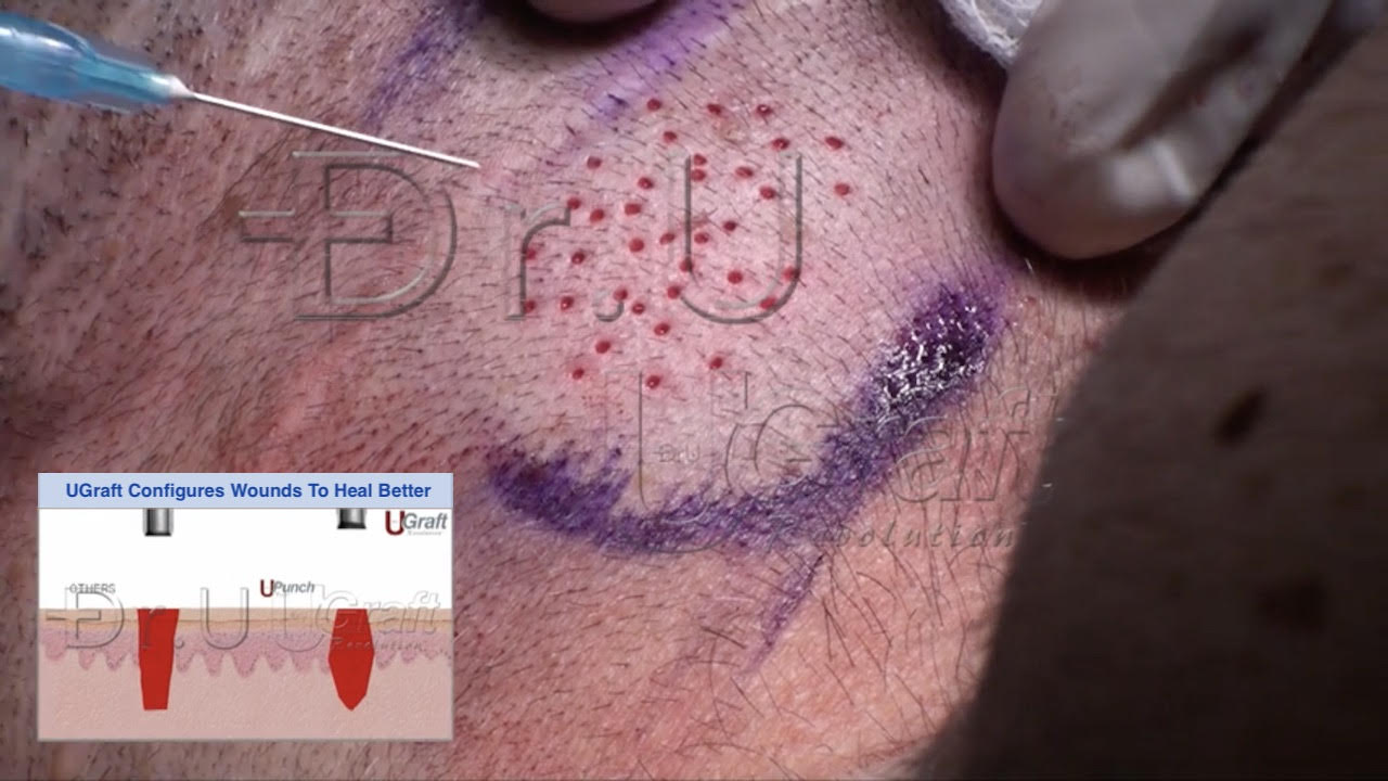A close-up view of a man's cheek during a hair replacement procedure. A stenciled guide is visible on the skin, with an area highlighted for treatment, and a needle injecting a substance into