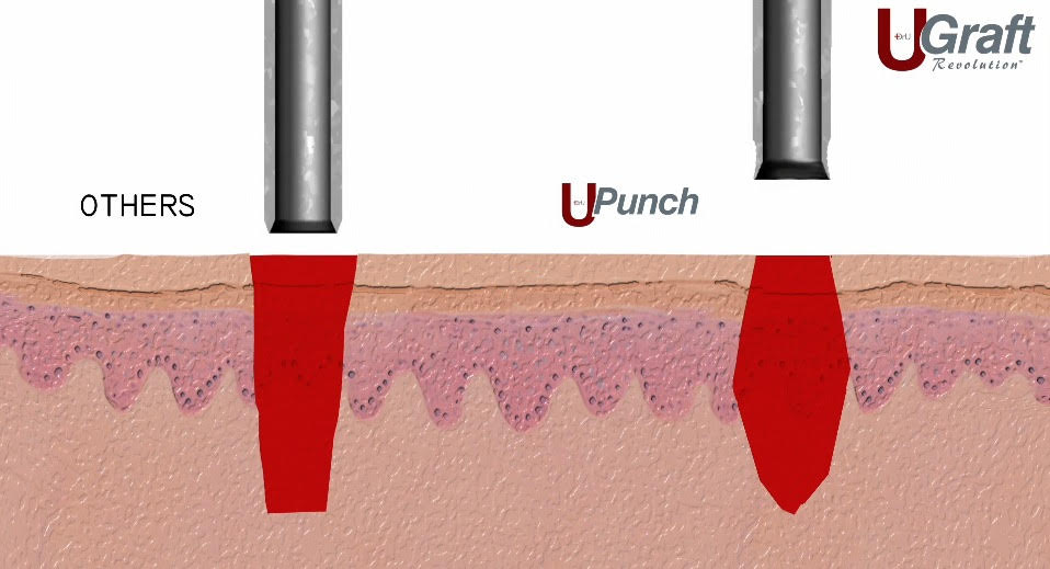 Illustration comparing traditional hair transplant tools ('others') with the 'u-punch' tool. The image shows how each tool interacts with the skin layers to remove a hair follicle, with u-p
