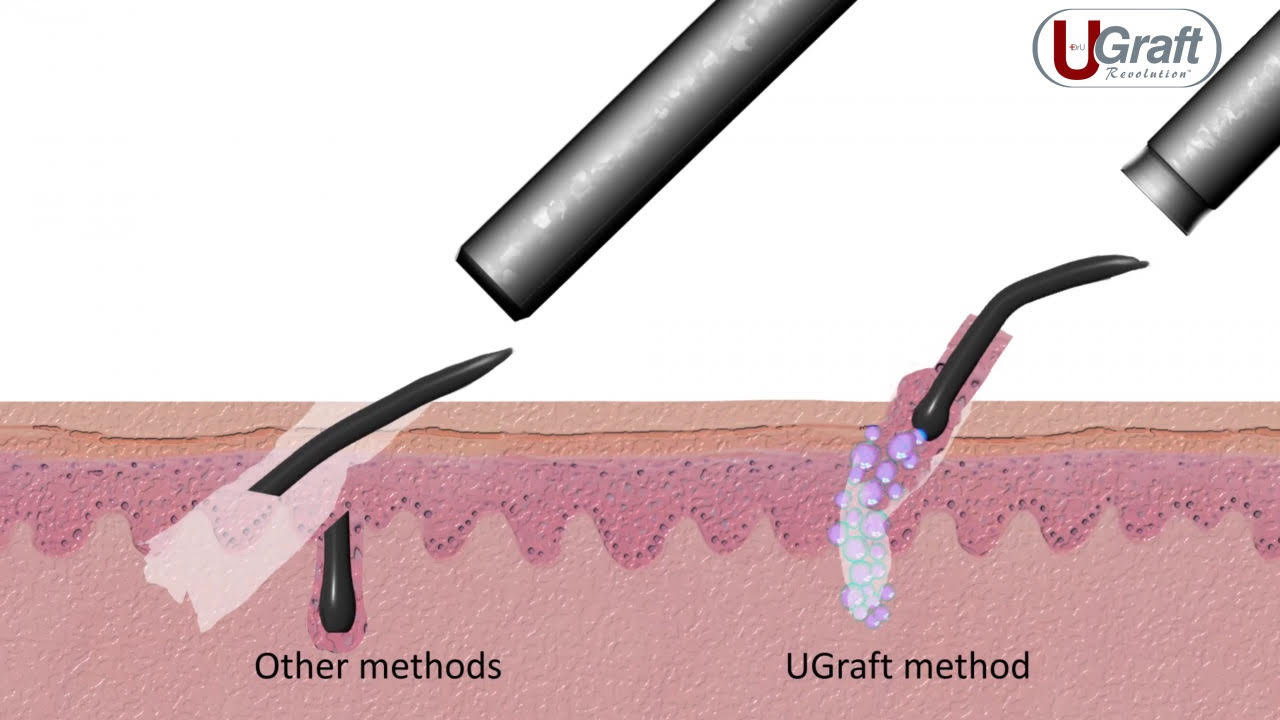 Illustration comparing two hair implant methods: traditional method on left with a black tool, and ugraft method on the right showing advanced technique with a purple tool and detailed grafting.