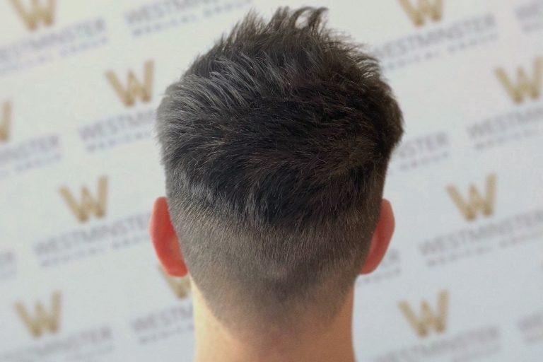 A person viewed from behind showcasing a stylish haircut with short sides and a textured top, crafted to address male pattern baldness, standing in front of a backdrop with repeated "w" logos.