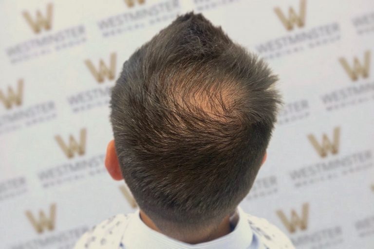 Back view of a person's head showcasing a short, styled haircut post-hair surgery against a backdrop with a repeated logo pattern.