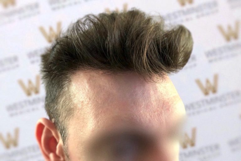 Close-up of a person's hairstyle featuring a voluminous, swept-back quiff, with a blurred background showing a logo pattern. The person’s face is blurred and not visible, hinting at male