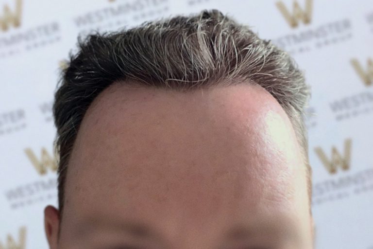 Close-up view of a person's forehead and hairline, featuring prominently styled gray and black hair following hair implant surgery, set against a blurred background with a logo watermark.