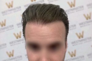 Close-up photo of a person's forehead and slicked-back hairstyle, likely addressing male pattern baldness, against a backdrop with a repeated "w" logo pattern. The person's eyes and lower face