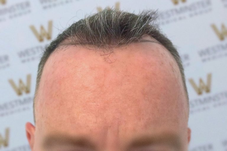 Close-up of a man's head showing hair regrowth on the top, marked by short, dark hair and a pale scalp. The background features a logo pattern.