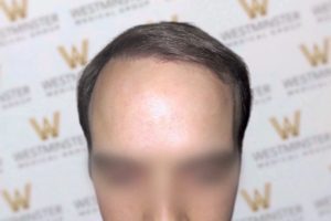 Close-up photo of a person's forehead and hairline, showing signs of male pattern baldness, with a blurred background featuring a repeated "w" logo. The face below the eyes is blurred out