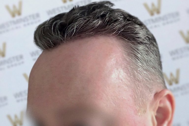 Close-up of a person's hair and forehead at an event with a blurred background showing a logo with letter "w". The hair, potentially enhanced by a hair replacement, is styled with a sweeping,