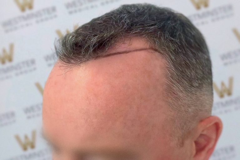 Close-up of a man's head showing a unique hairstyle with hair regrowth, featuring a shaved pattern on the sides and longer, curly hair on top, against a backdrop with a repeated logo pattern.