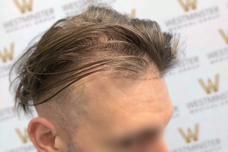 Close-up of a person's side profile focusing on a stylishly swept, slightly tousled hairdo with shaved sides indicative of male pattern baldness. The background features a repetitive logo pattern.