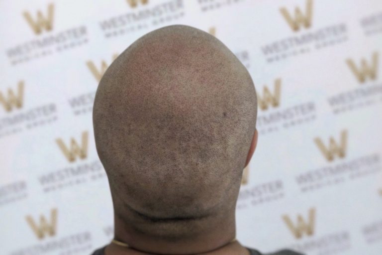 Back view of a bald man's head, showing some hair regrowth and freckles, set against a backdrop with multiple light-colored "w" logos on a darker background.