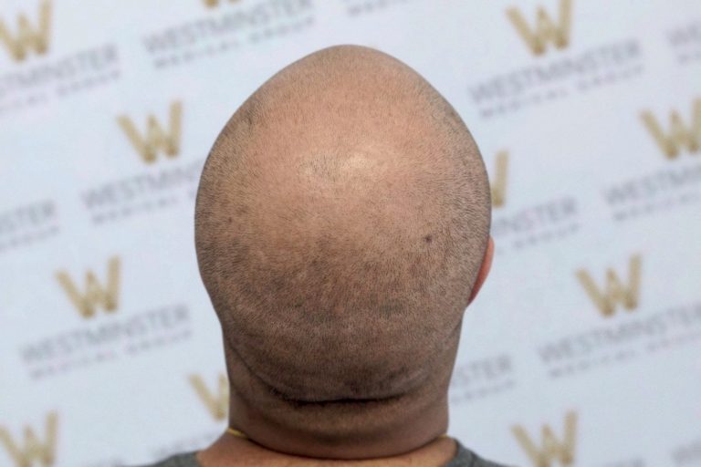 Back view of a person's head showing signs of male pattern baldness, in front of a background featuring logos with the letter "w" repeated in a pattern.