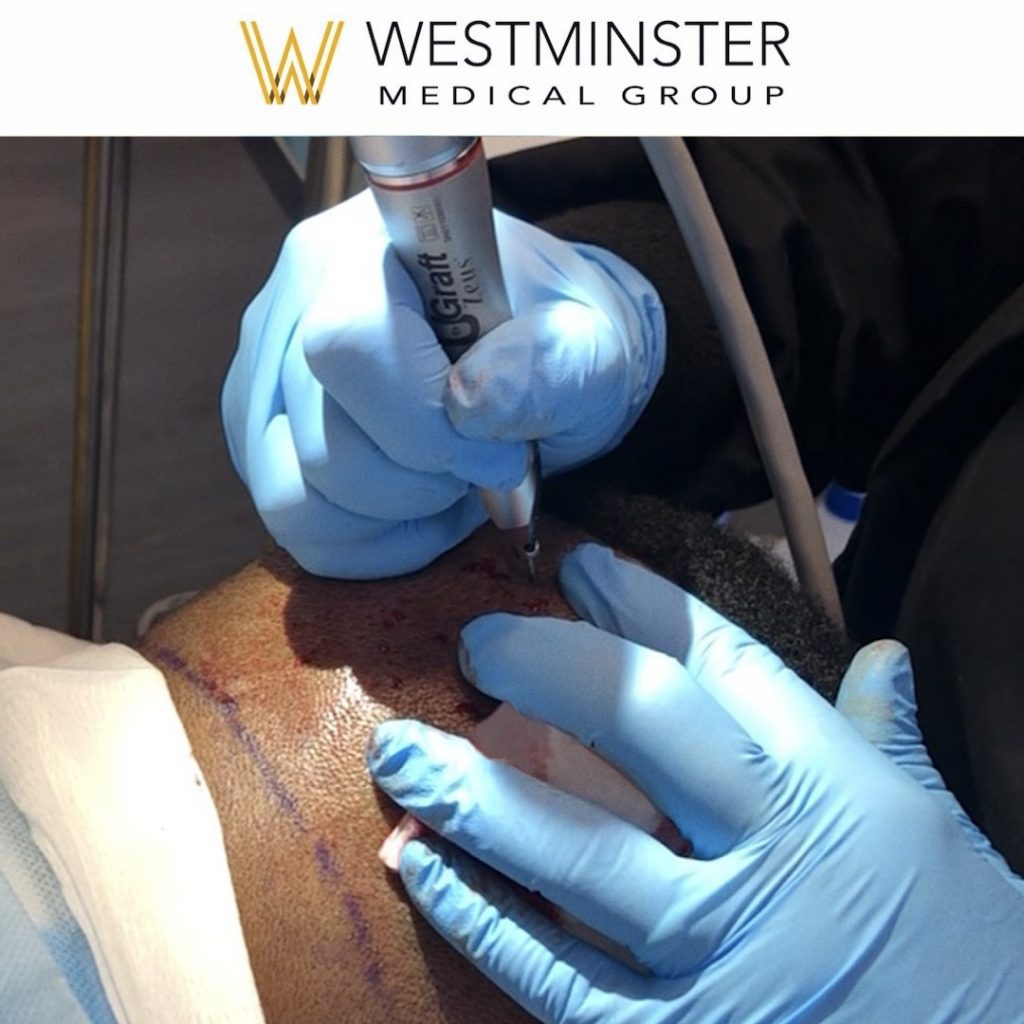 Gloved hands perform a hair replacement procedure involving a syringe on a patient's scalp, with the logo of Westminster Medical Group visible.