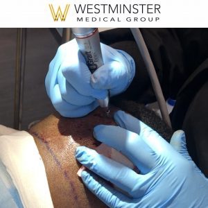 Gloved hands perform a hair replacement procedure involving a syringe on a patient's scalp, with the logo of Westminster Medical Group visible.