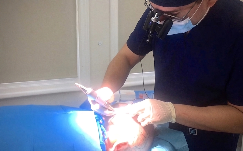 A dentist wearing a surgical mask and loupes is performing a hair surgery on a patient lying on a dental chair, using a dental handpiece under bright lighting.