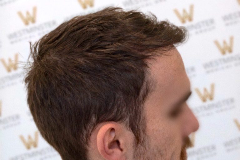 Close-up view of a man's profile with a focus on his stylishly tousled brown hair, standing against a blurred background with a logo pattern.