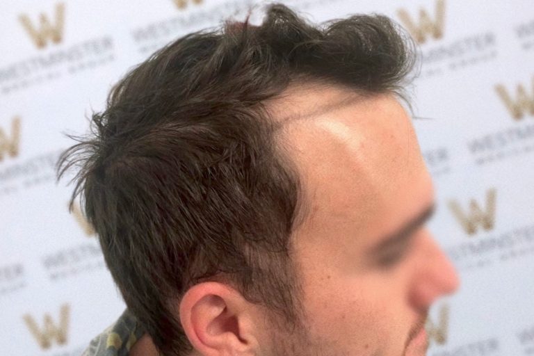 Side profile of a man with dark hair showing signs of hair regrowth, set against a backdrop with a repeated 'w' logo.