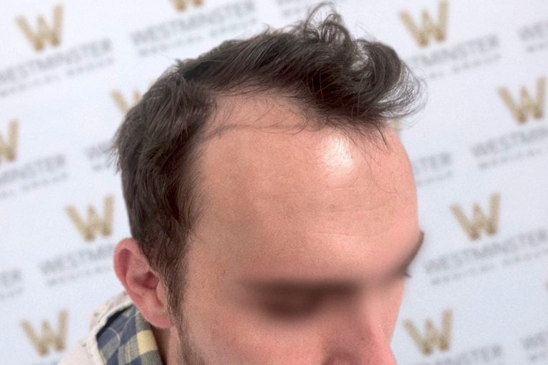 fue hair transplant london