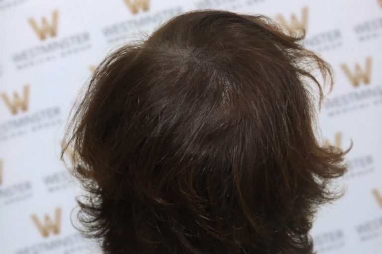 Close-up of a person's brown, tousled hair regrowth, covering their head against a background showing multiple logos of the Westminster Dog Show.