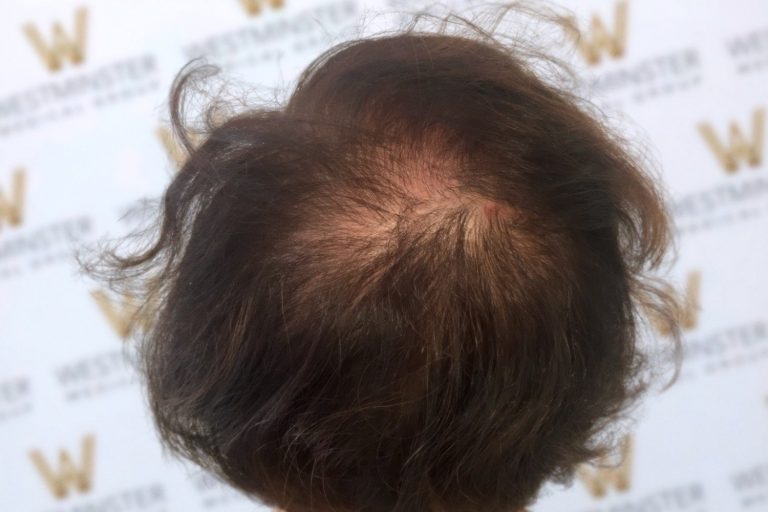 Top view of a person's head showing male pattern baldness with thinning hair and visible scalp, set against a backdrop with repeated "ww" logos.
