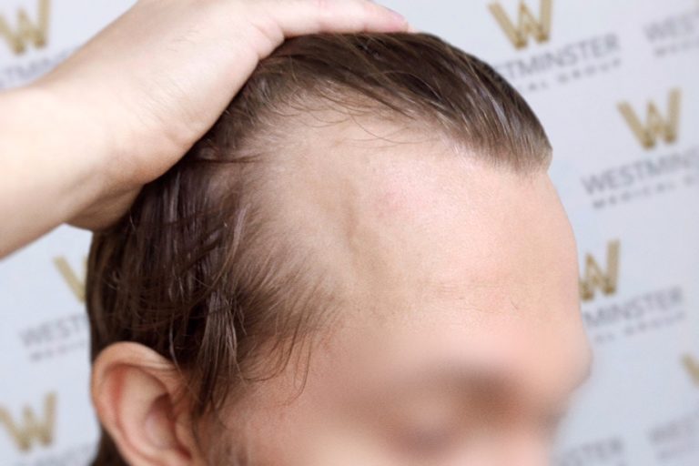 Close-up of a person experiencing significant hair loss, showing a large bald patch on the top of their head. Their hand is placed on their head, partially brushing through the thinning hair, contemplating hair