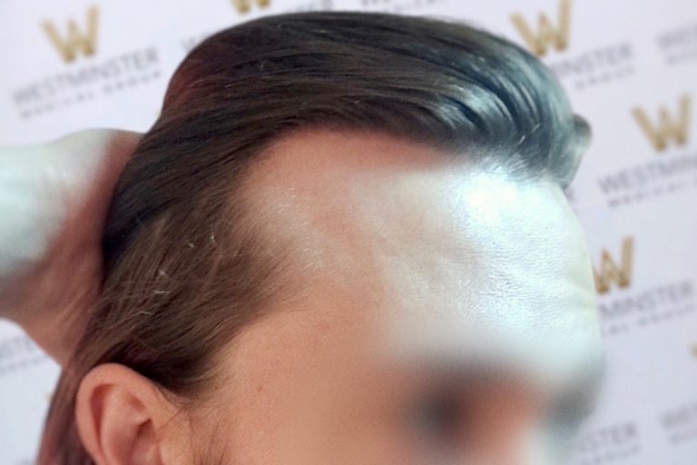 Close-up of a person's styled hair implant and forehead, with a logo backdrop blurred in the background. Details highlight the hair texture and sleek hairstyle. Face is out of focus and partially visible.