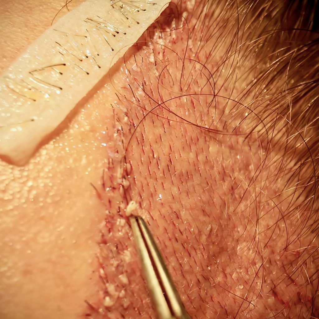 Close-up image of a person's skin undergoing hair surgery with tweezers, showing detailed stitching and healing wound.