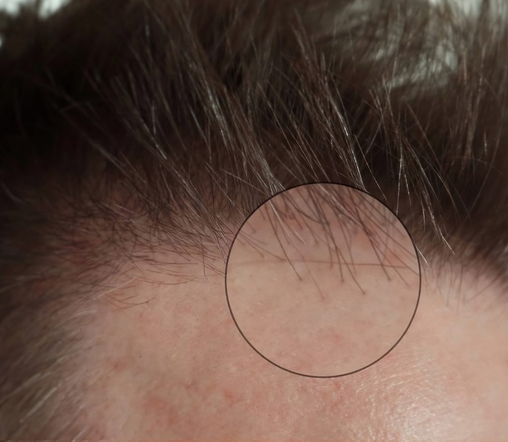 Close-up of a human scalp with thinning hair due to female hair loss, showing visible skin and a few strands within a highlighted circle.