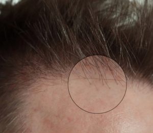 Close-up of a human scalp with thinning hair due to female hair loss, showing visible skin and a few strands within a highlighted circle.