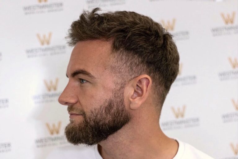 Profile view of a man with a stylish, textured haircut and a full beard, looking to the right in front of a background with a logo pattern after successful hair replacement.