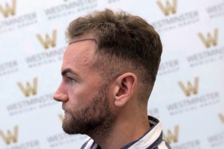 Side profile of a man with a modern haircut from recent hair surgery, featuring short sides and a longer, textured top. He's in front of a background with a repeating logo pattern.