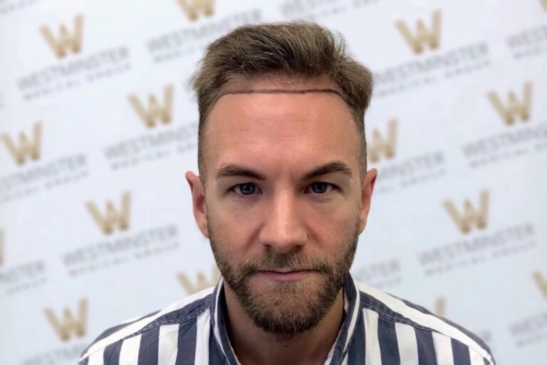 A man with light stubble and hair regrowth, giving a subtle smile, wearing a striped shirt, in front of a wall with a repetitive 'w' logo pattern.