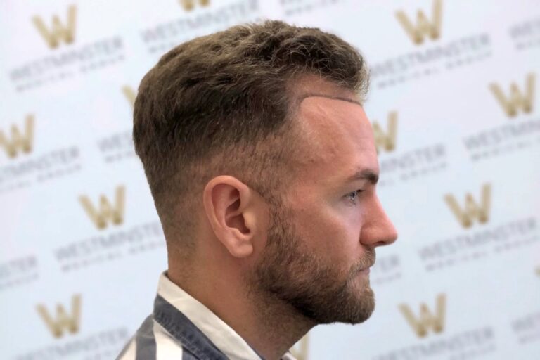 Profile view of a man with a modern haircut standing against a backdrop with a repeated 'w' logo. He has undergone hair implant surgery, has a trimmed beard, and is wearing a striped shirt.
