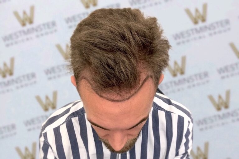Top-down view of a man's head with thinning hair, possibly considering hair replacement, wearing a striped shirt, against a backdrop with multiple "westminster" logos.