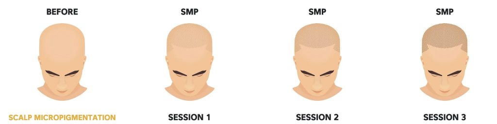 Comparison of scalp micropigmentation on a bald head across three sessions, showing progressive hair density from none to full coverage, addressing female hair loss.