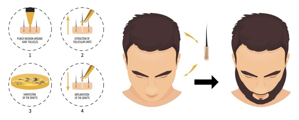 An illustrated guide showing steps to apply hair product for managing male pattern baldness. Steps include placing, distributing, hydrating, and styling the hair from a front view to a side view with beard.