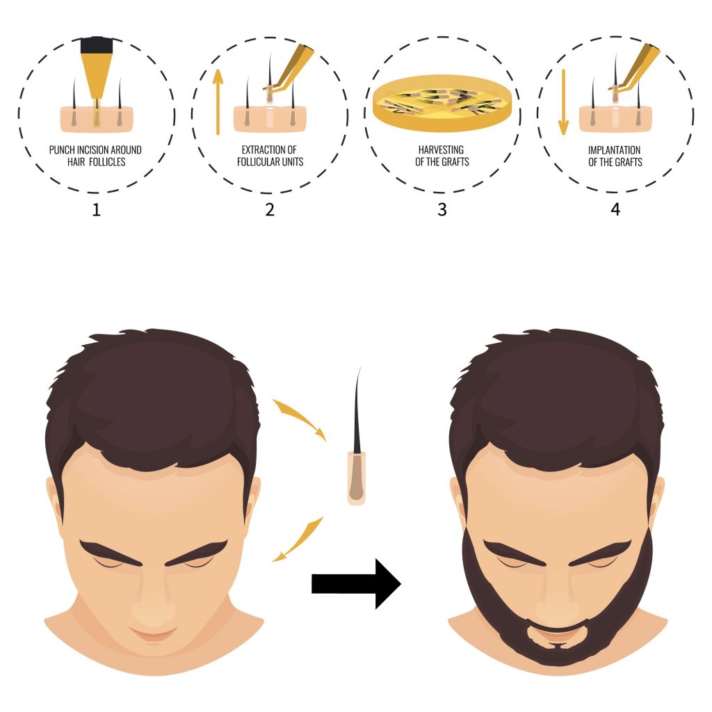 Illustration depicting four stages of a hair replacement procedure: 1) punch incision around hair follicles, 2) extracting the follicles, 3) harvesting the grafts, 4