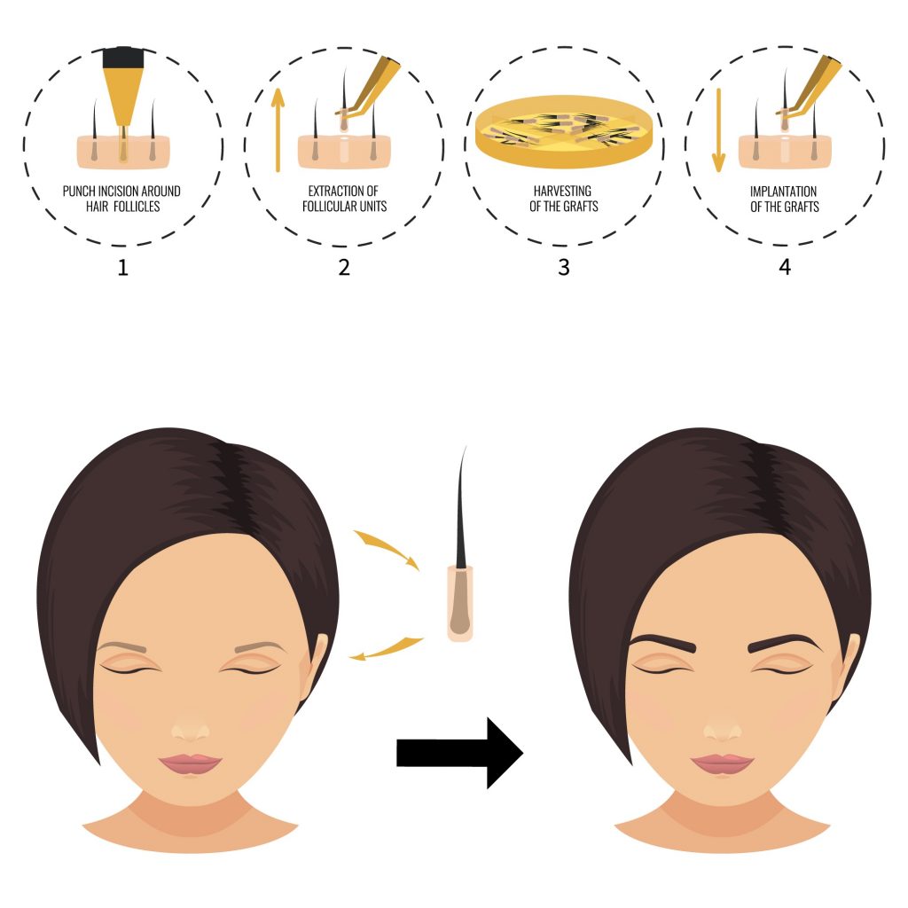 Illustration depicting the process of hair implantation in four steps: 1) punch incision around hair follicles, 2) extraction of follicles, 3) harvesting the grafts,