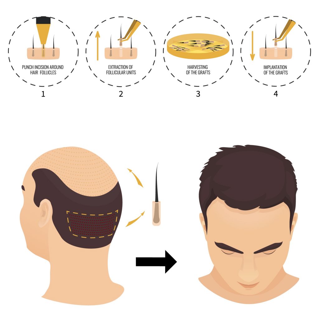 Illustration of the hair transplantation process. step 1: punch incision around hair follicles. step 2: extracting follicular units. step 3: harvesting the grafts. step