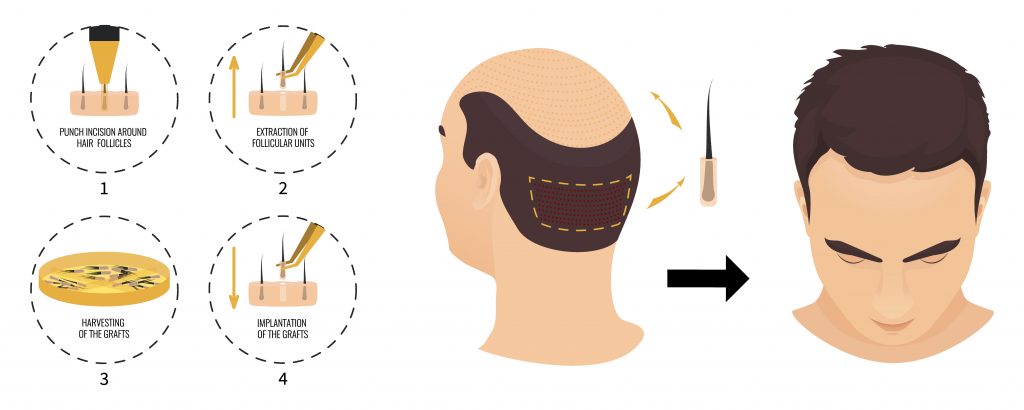 Illustration showing the process of hair transplantation for female hair loss. Steps include removing follicles, preparing them, creating recipient sites on the scalp, and inserting hair follicles to achieve growth.