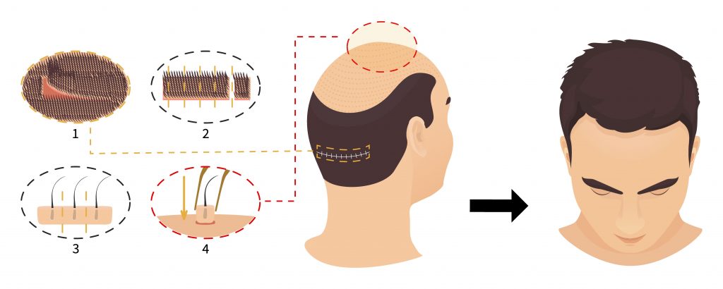 Illustration depicting stages of a hair replacement procedure, with close-up details of follicle extraction and implantation, and a side-to-front view of a man's head showing the results.