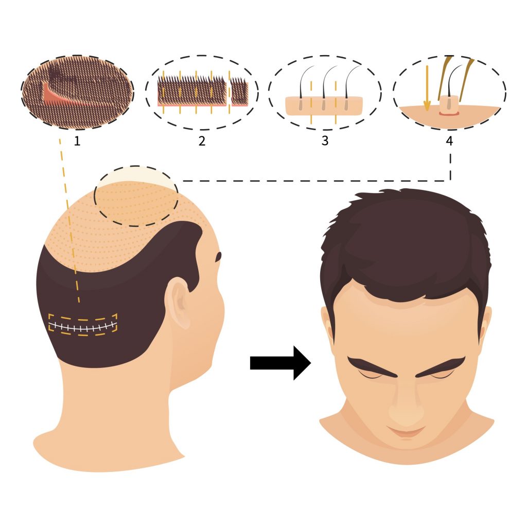 Illustration of a hair transplant process for male pattern baldness showing the donor area's extraction and the placement of hair follicles on a recipient's head, with numbered step-by-step diagrams.