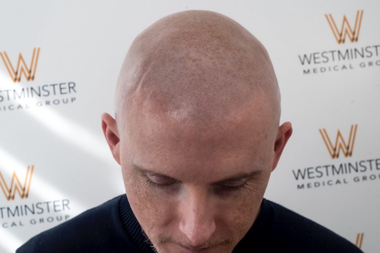 Close-up of a bald man's head, showing signs of male pattern baldness, looking downwards, against a backdrop with the Westminster Medical Group logo.